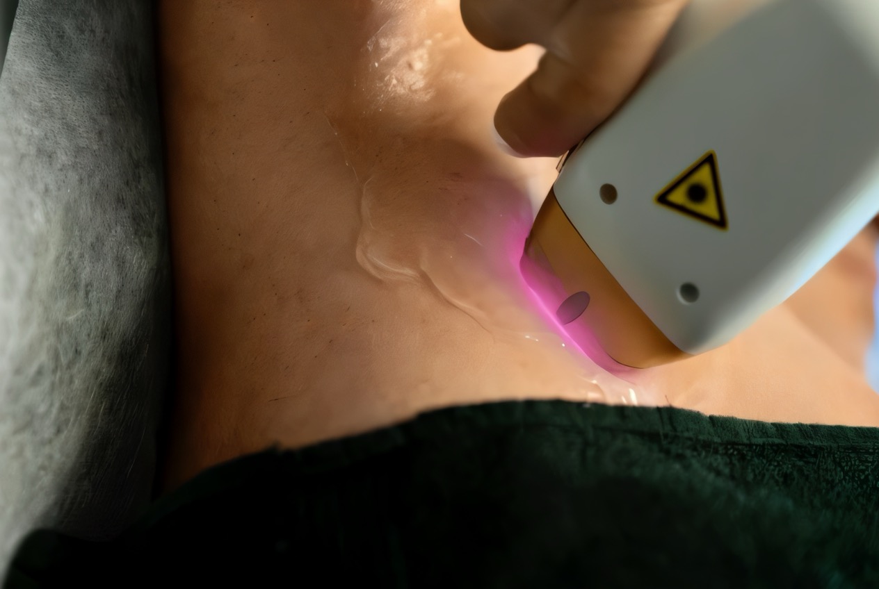 Laserontharing bij Less is More β blijvend gladde huid